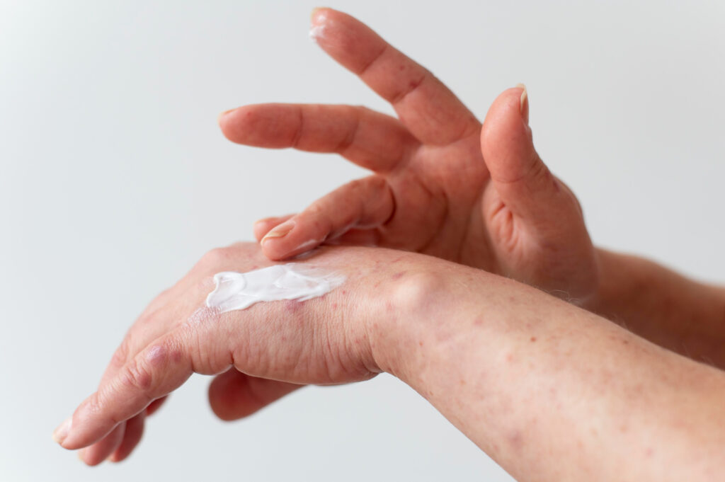 calamine vs caladryl lotion